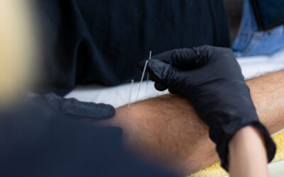 Da li je Dry Needling bolan?